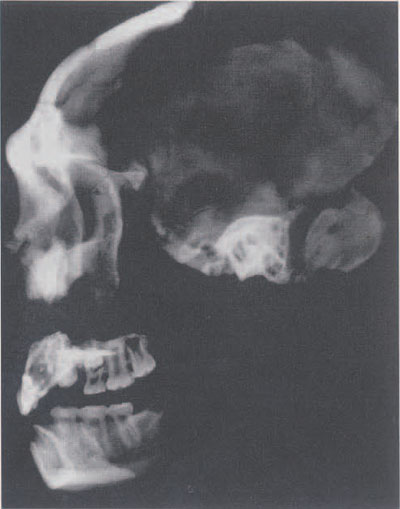 From X-rays, it is revealed that the "C" individual dies as a teenager. Given that the fossils were found scattered over the expanse of the cave, it seems that some of these bones should belong to single individuals. This is a "composite" individual; the upper and lower jaw may belong to the "C" skull. Certainly these are bone remains of individuals that dies at about the same age.
