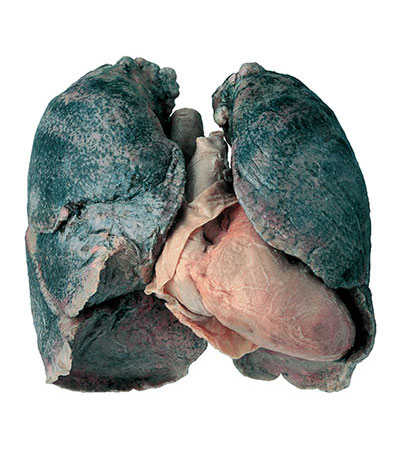 The heart and lungs of a smoker, the lungs are blue-black from damage.