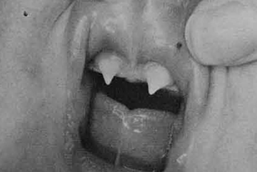 The gums of a child with two fang-like teeth protruding through.