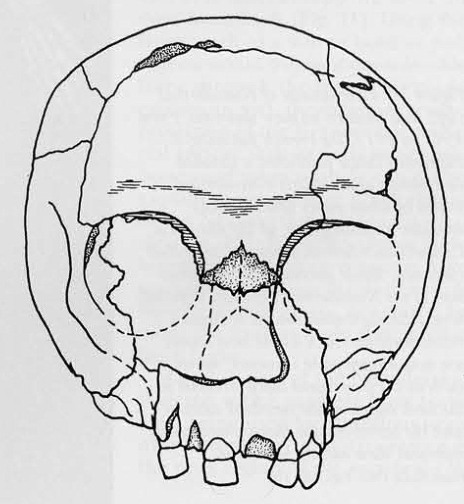 Drawing of a neanderthal child skull pieces together from fragments.
